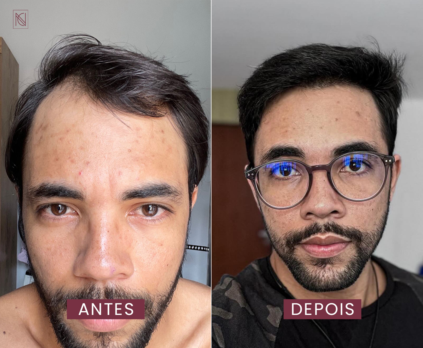 antes 3